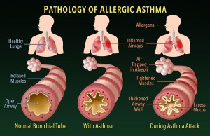 Medical - Asthma